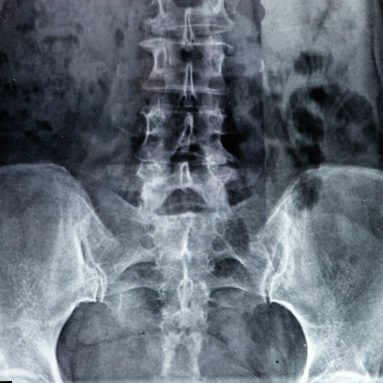 x-rays